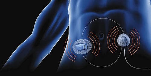 Are Artificial Pancreas vulnerable to cyber attacks?